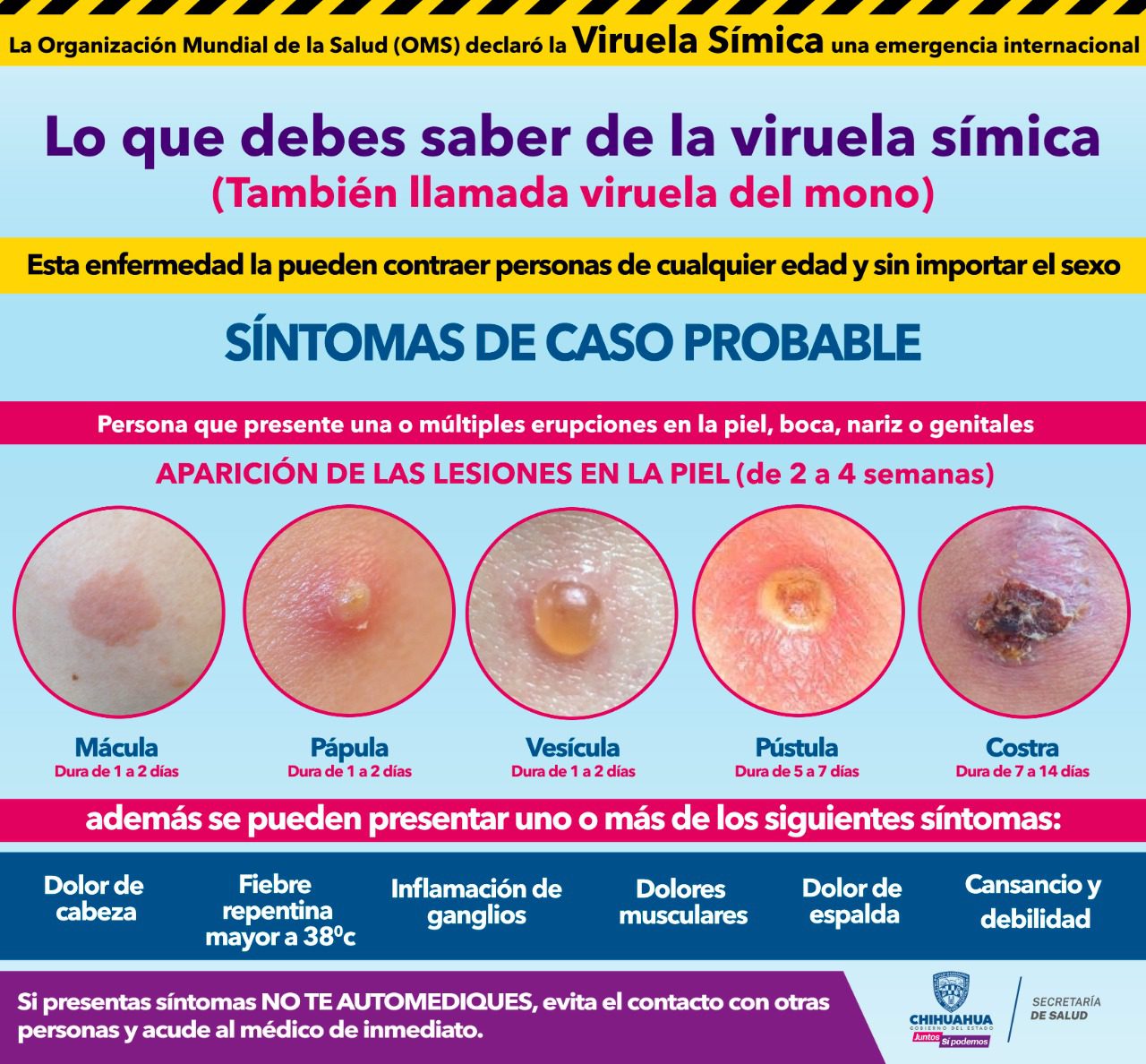 Emite Secretaría de Salud medidas de prevención ante viruela símica