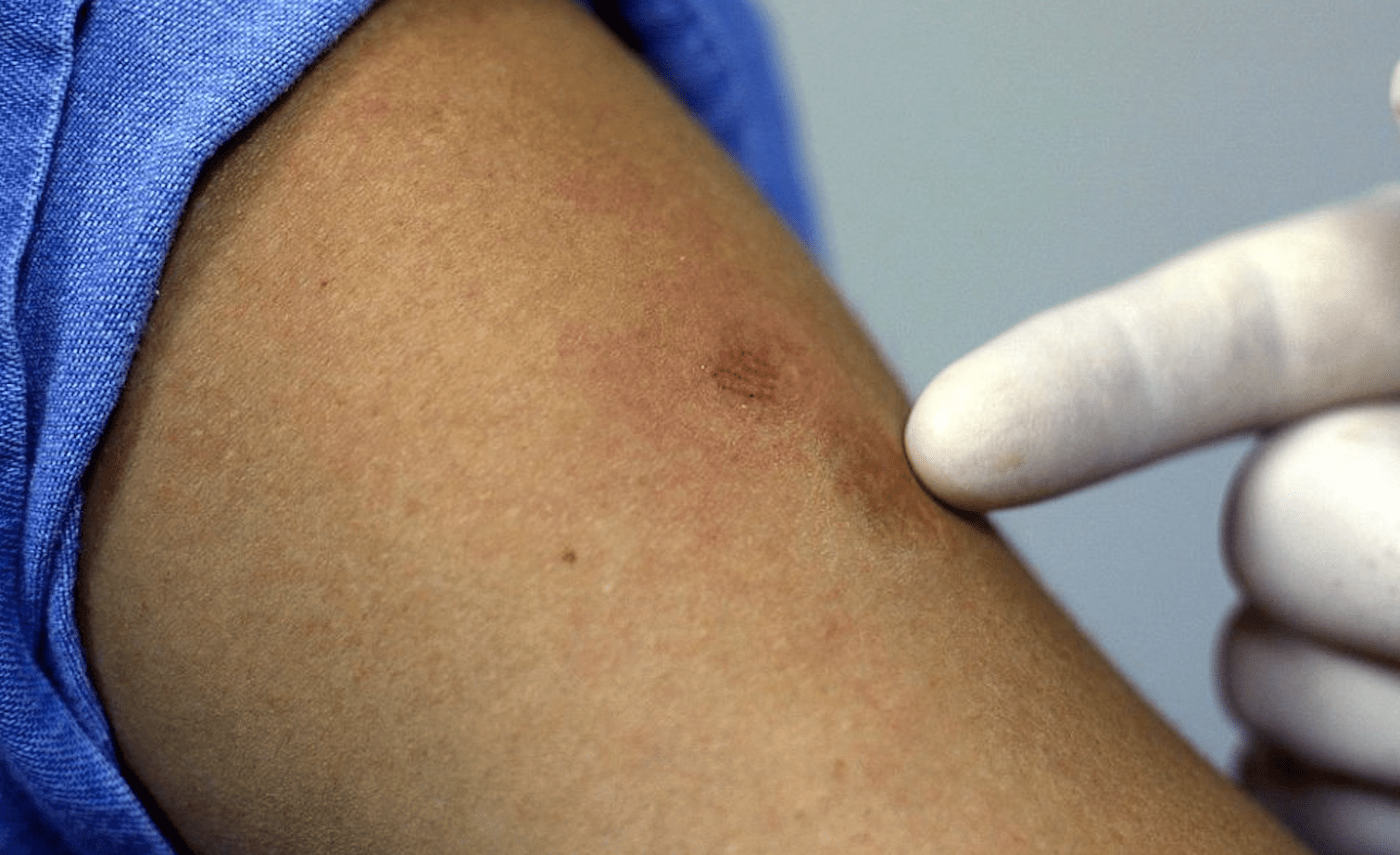 Emiten recomendaciones para prevención de contagios de viruela símica