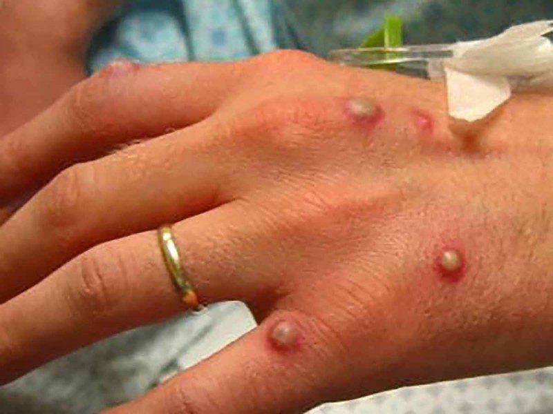 Promueve Secretaría de Salud medidas preventivas contra la viruela símica