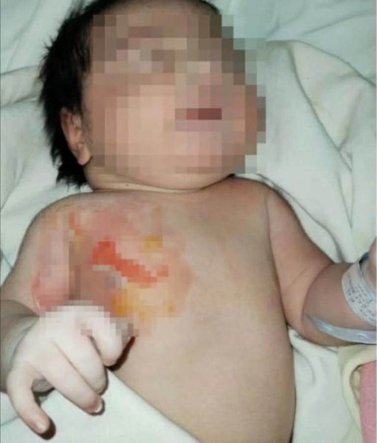 Personal del IMSS Durango quema a bebé y encubre el accidente