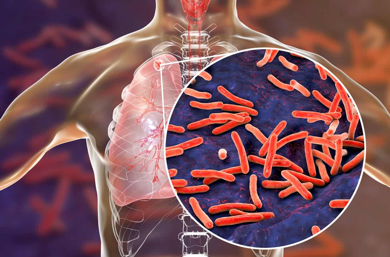 Recomiendan protegerse y prevenir la tuberculosis